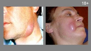 Флюс - симптомы и стадии лечения (периостит зуба)