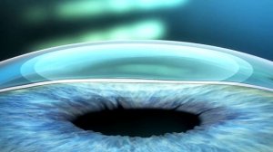 ReLEx SMILE и ReLEx SMILE pro — визуализация процесса коррекции зрения