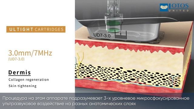 Ultight: об аппарате смотреть онлайн