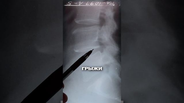 Остеохондроз и грыжи: что делать при боли в спине? смотреть онлайн