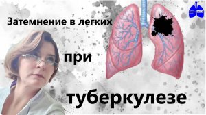 Затемнение в легких при туберкулезе
