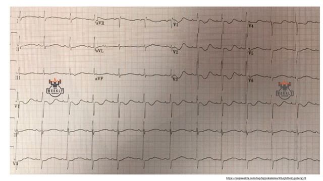 Электрокардиографические признаки метаболических и эндокринных расстройств смотреть онлайн