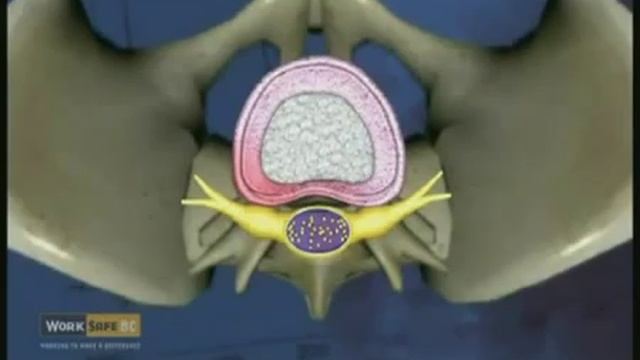 Образование межпозвонковой грыжи смотреть онлайн