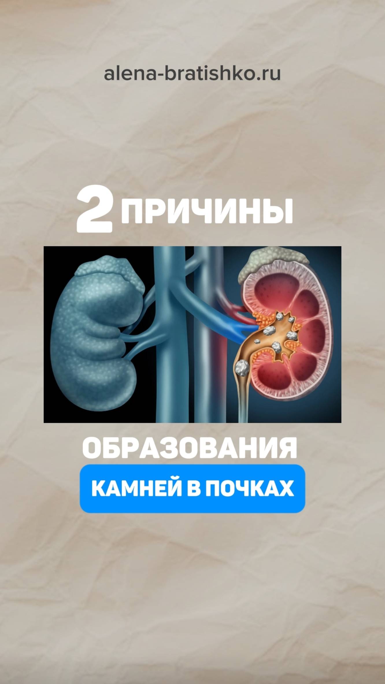 2 причины, из-за которых образуются камни в почках. Семейный доктор Алена Братишко смотреть онлайн