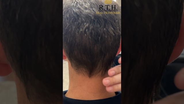 6 месяцев после пересадки волос: Первые видимы результаты смотреть онлайн