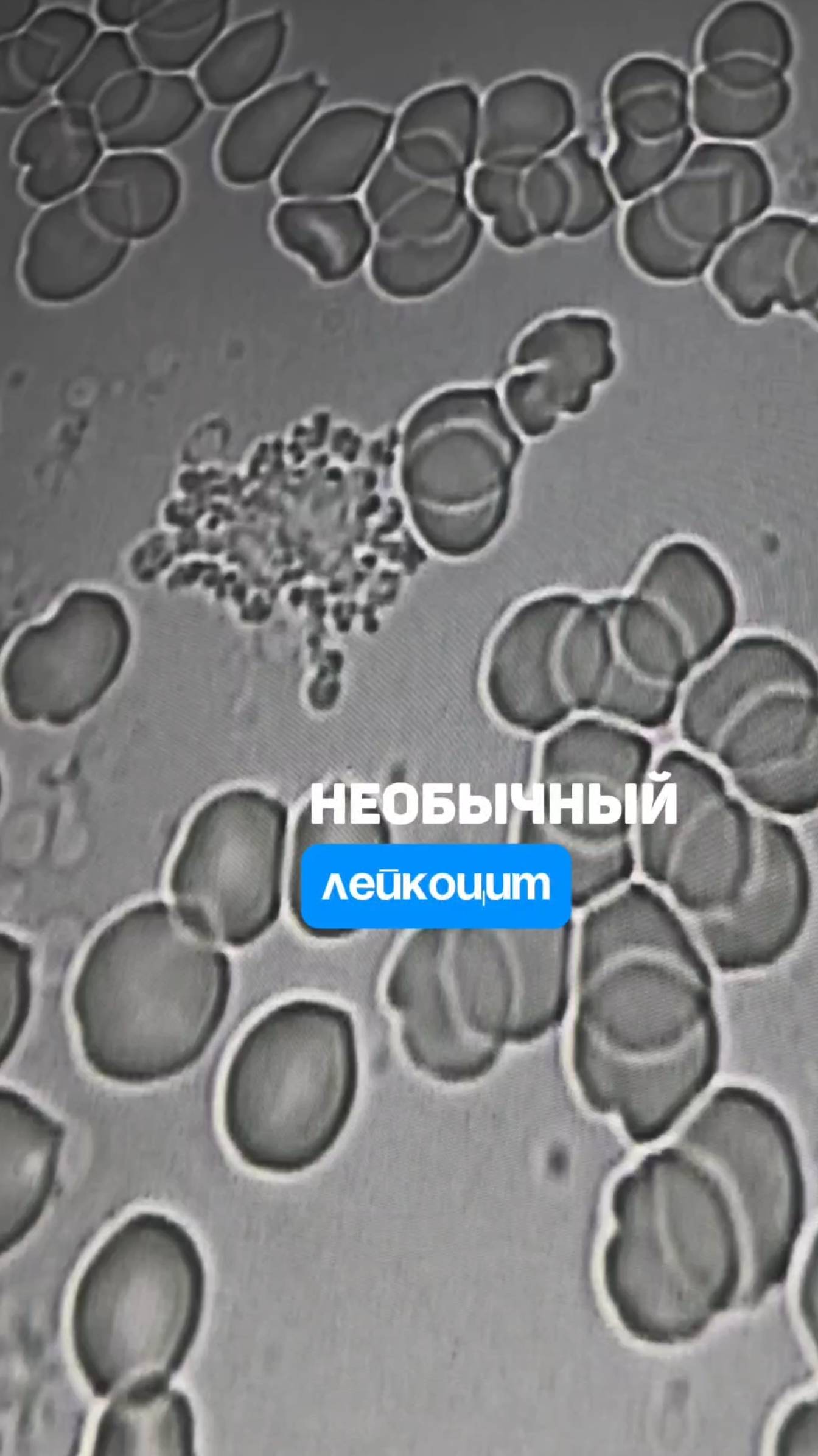 Лейкоцит "медуза". Семейный доктор Алена Братишко смотреть онлайн