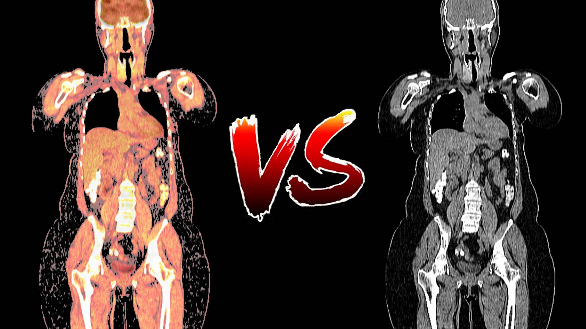 ПЭТ/КТ против КТ. Какое исследование лучше?