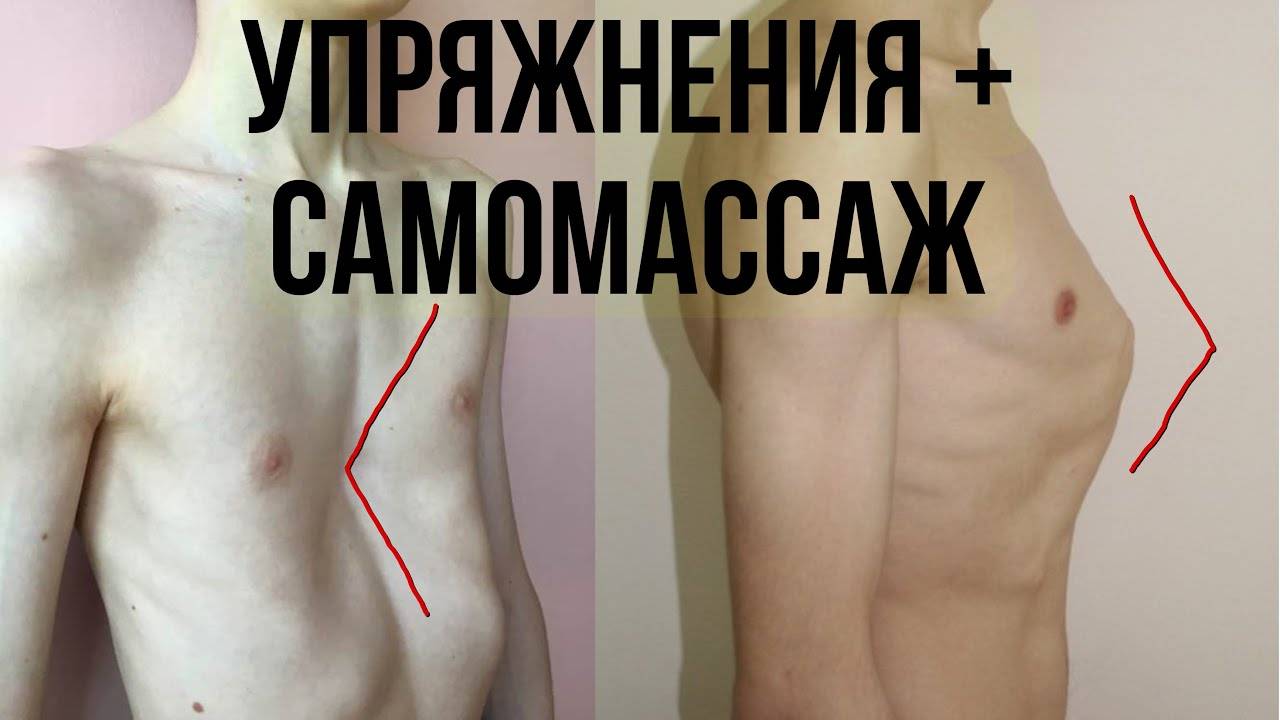 деформация грудной клетки ВПАЛАЯ, КИЛЕВИДНАЯ смотреть онлайн
