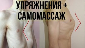 деформация грудной клетки ВПАЛАЯ, КИЛЕВИДНАЯ