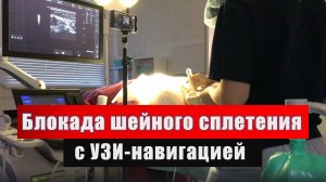 БЛОКАДА ШЕЙНОГО СПЛЕТЕНИЯ
#regionalanesthesia #узинавигация #регионарнаяанестезия #шейноесплетение