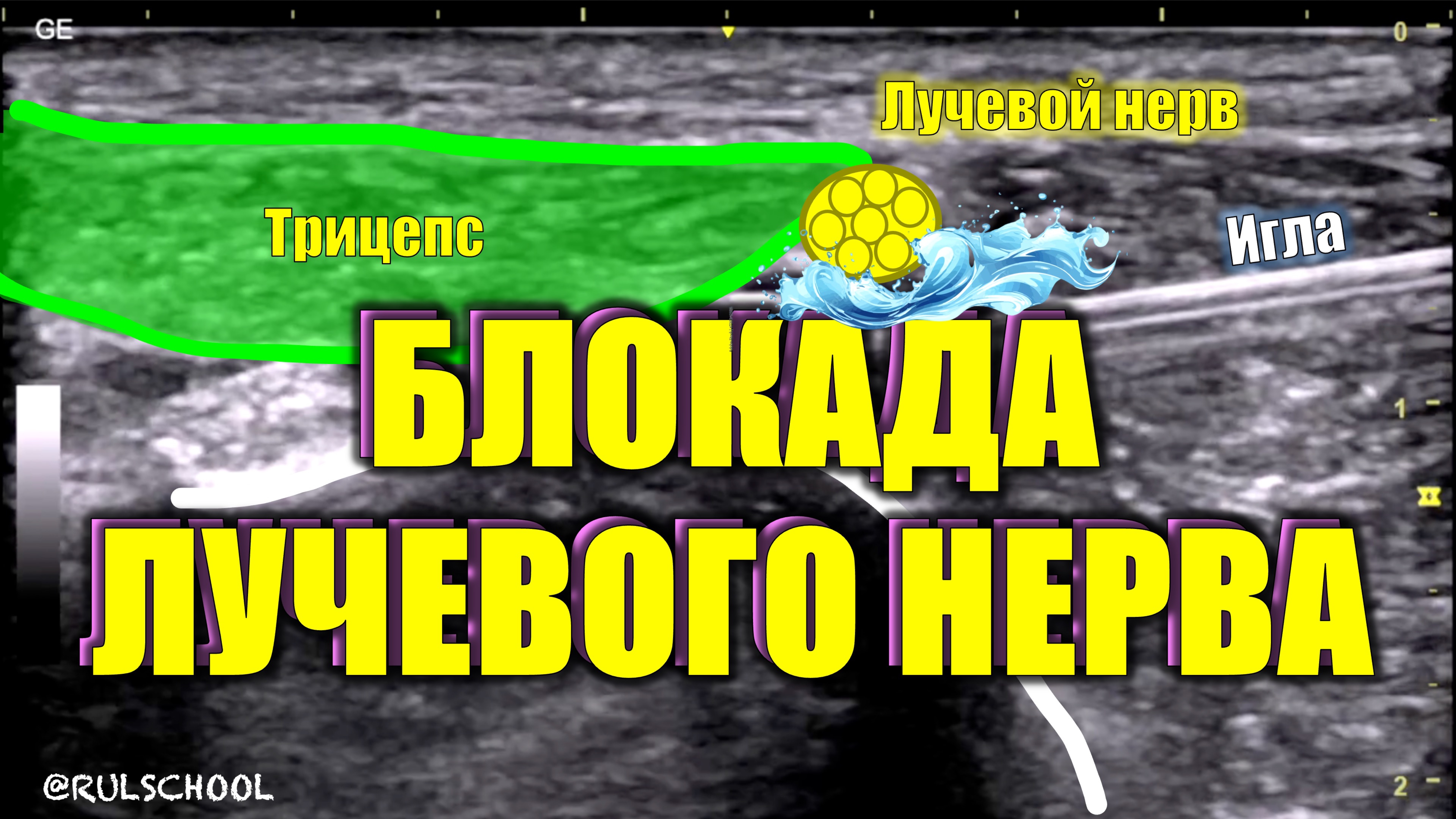 РЕГИОНАРНАЯ АНЕСТЕЗИЯ