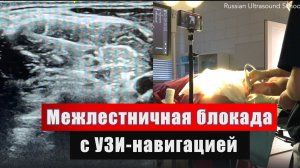 МЕЖЛЕСТНИЧНАЯ БЛОКАДА ПЛЕЧЕВОГО СПЛЕТЕНИЯ
#regionalanesthesia #узинавигация #регионарнаяанестезия