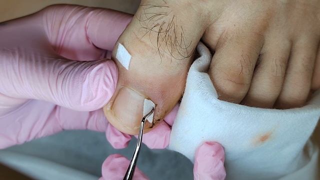 Вросший ноготь после травмы/ установка тампонады