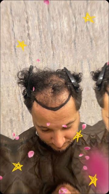 Пересадили 4.700 графтов FUE. Пересадка волос.#стамбул #ту?