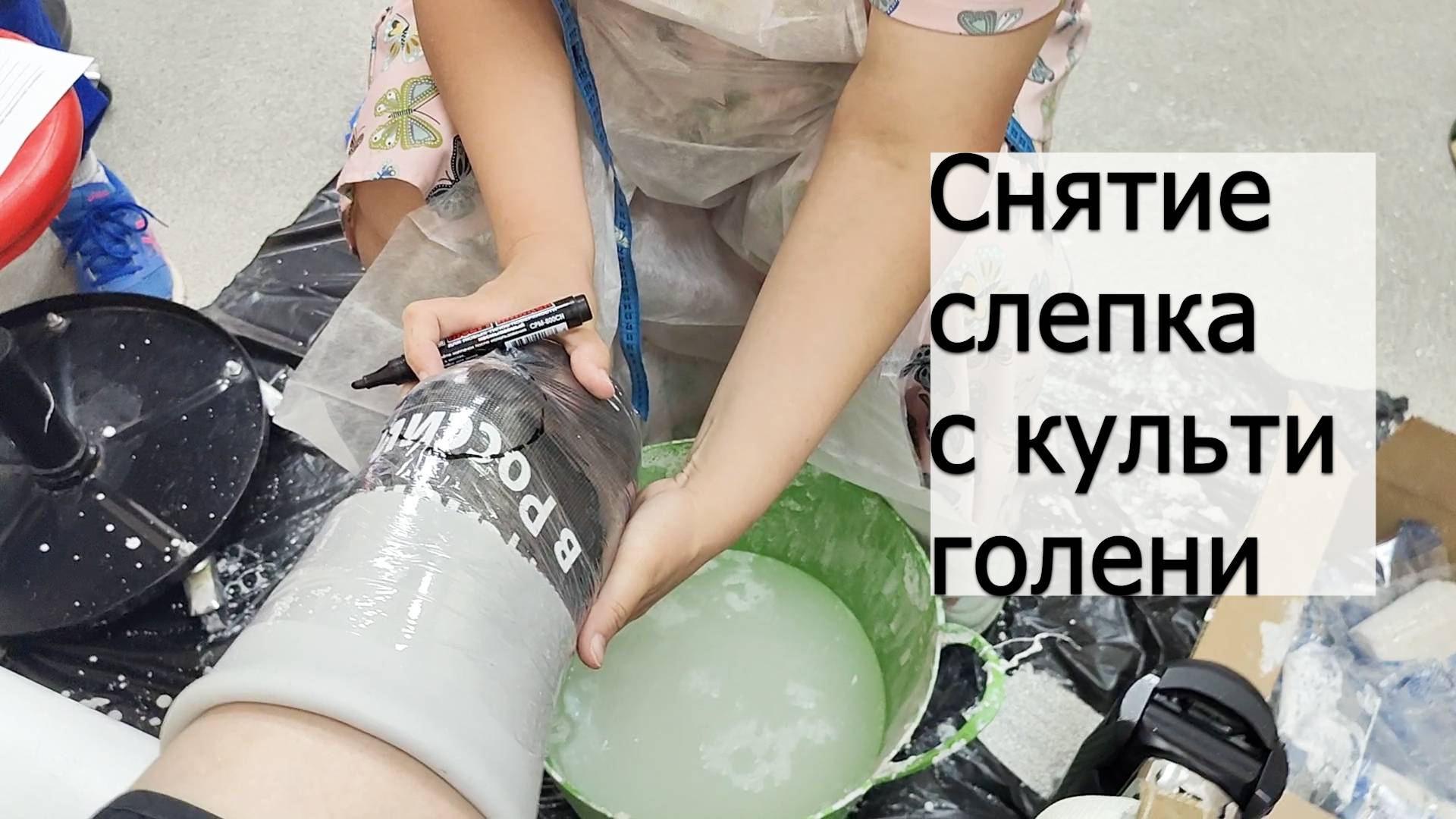 Снятие гипсового слепка с культи голени смотреть онлайн