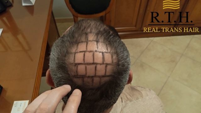 Облысение 4 степени? Решено! смотреть онлайн