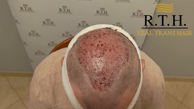 Хирург Иван Двинских завершил пересадку волос для пациента с 4 степенью облысения! смотреть онлайн