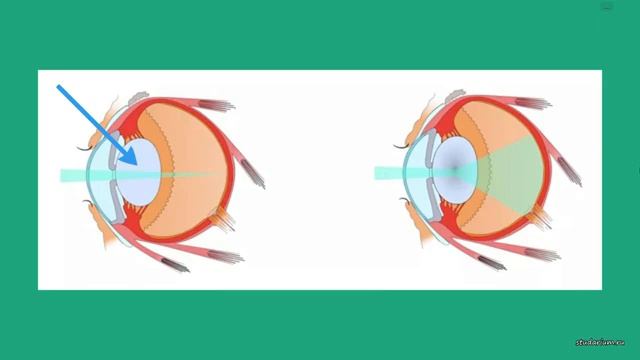 Орган зрения. Анатомия и физиология глаза. Болезни. Лекция и разбор заданий от Юрия Беллевича смотреть онлайн
