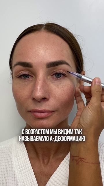 Как УБРАТЬ ДЕФОРМАЦИЮ ВЕРХНИХ ВЕК?! #красота #здоровье #пластика #хирургия #блефаропластика