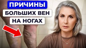 СРОЧНО проверь свои НОГИ! / Как лечить варикоз дома БЫСТРО и БЕЗ ЛЕКАРСТВ?