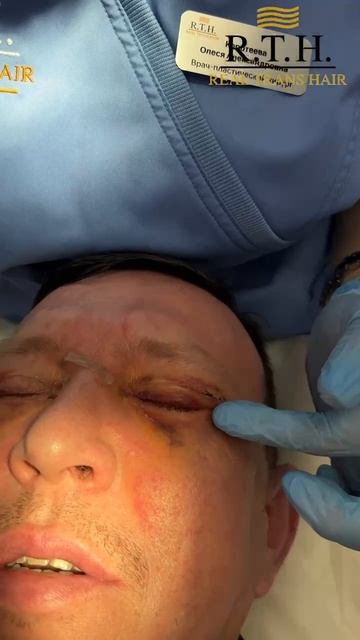 Мужская блефаропластика: 5 дней после операции смотреть онлайн