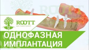 Однофазная (базальная)  имплантация, нижняя челюсть.  ROOTT.Видео однофазной  (базальной)имплантации