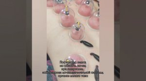 Постановка пиявок на область почек