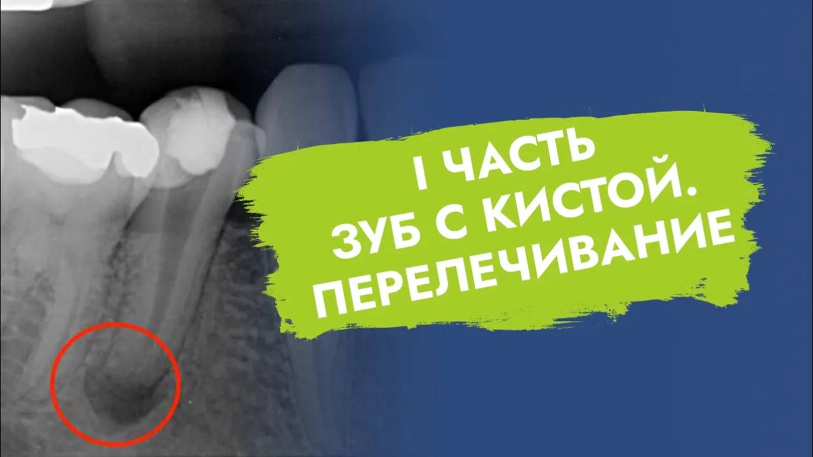 Не удаляйте зуб с кистой. Есть возможность его сохранить!