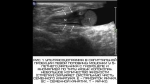 Перекрут  яичка на УЗИ