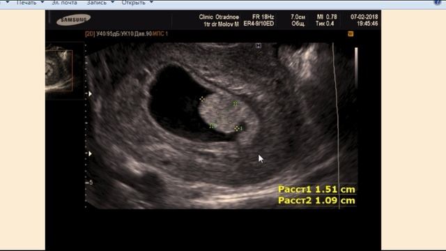 Хорионик бамп на УЗИ Chorionic Bump