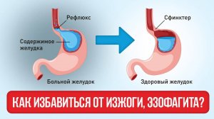 _Что Делать при Эзофагите и ГЭРБ_ Правильное Лечение и Запреты_