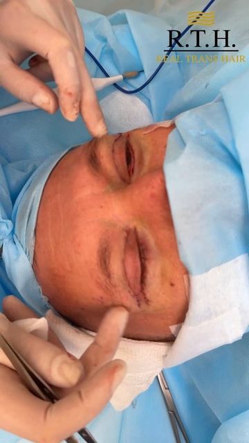 Мужская блефаропластика смотреть онлайн