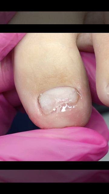 Протезирование при псориазе