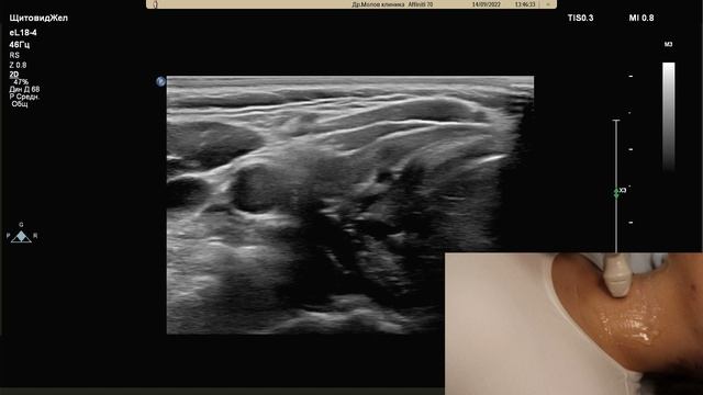 УЗИ щитовидной железы смотреть онлайн