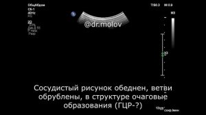 Цирроз печени на УЗИ