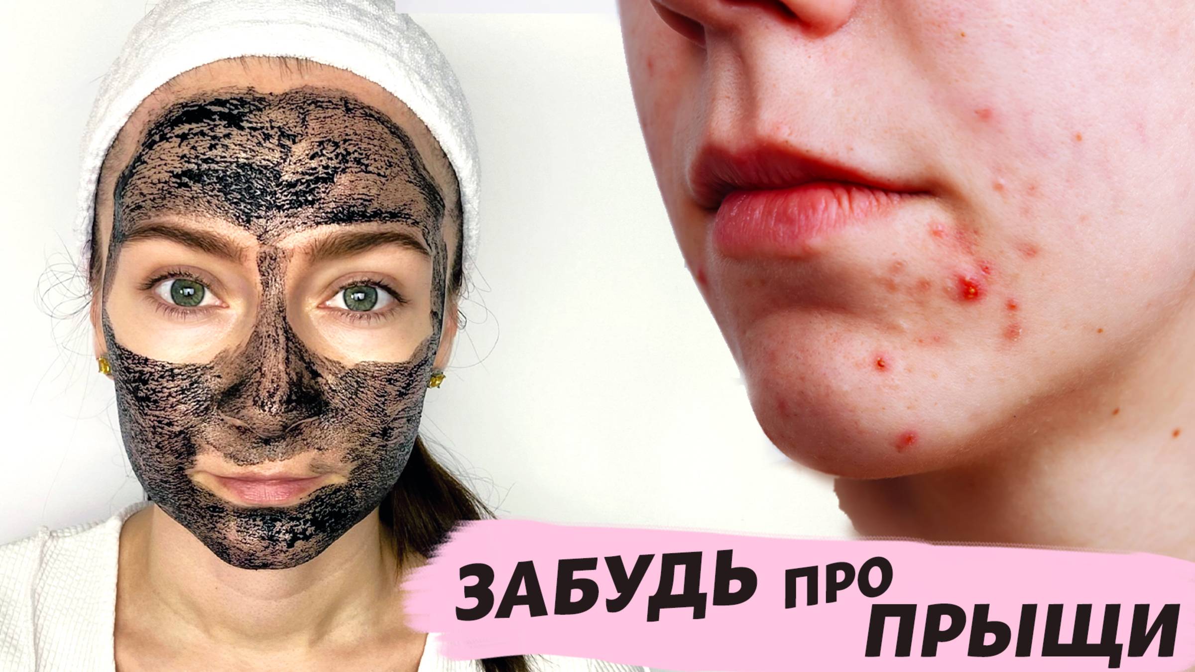 СУПЕР СРЕДСТВО от АКНЕ! УБЕРЁТ ПРЫЩИ и ЧЁРНЫЕ ТОЧКИ за НЕДЕЛЮ! Супер чистка лица в домашних условиях смотреть онлайн