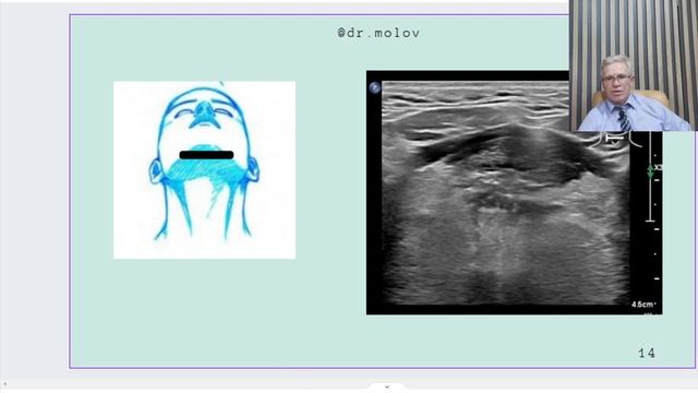 слюнные железы на УЗИ смотреть онлайн