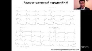 Электрокардиографические проявления ишемического поражения миокарда при остром коронарном синдроме