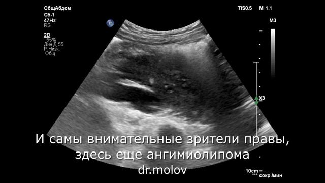 Дистопия почки  2