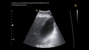 Цирроз печени на УЗИ