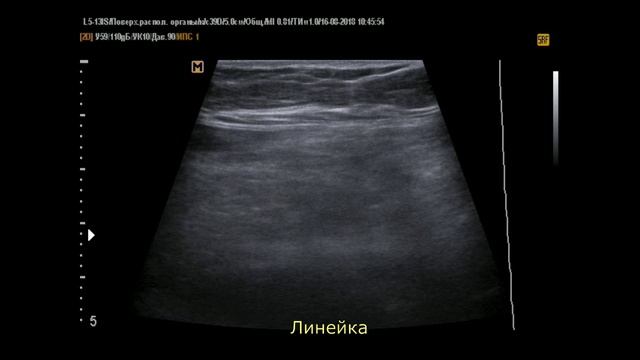 О аппендицит на УЗИ ( 1) смотреть онлайн