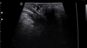 Свищ прямой кишки на УЗИ