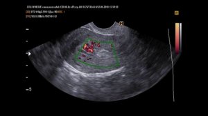 Патология полости матки на УЗИ