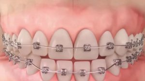 Как работают брекеты и как они меняют ваше лицо