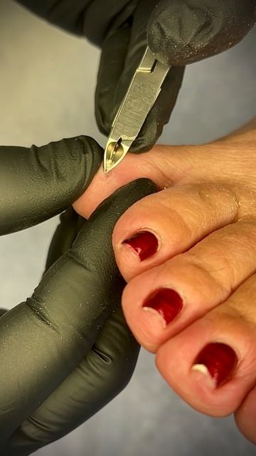 Хромота из-за кожного уплотнения между пальцев смотреть онлайн