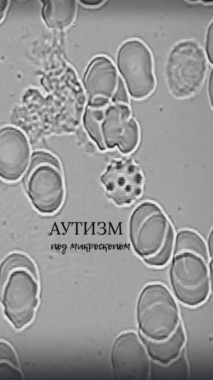Аутизм у детей. Клетки крови под микроскопом смотреть онлайн