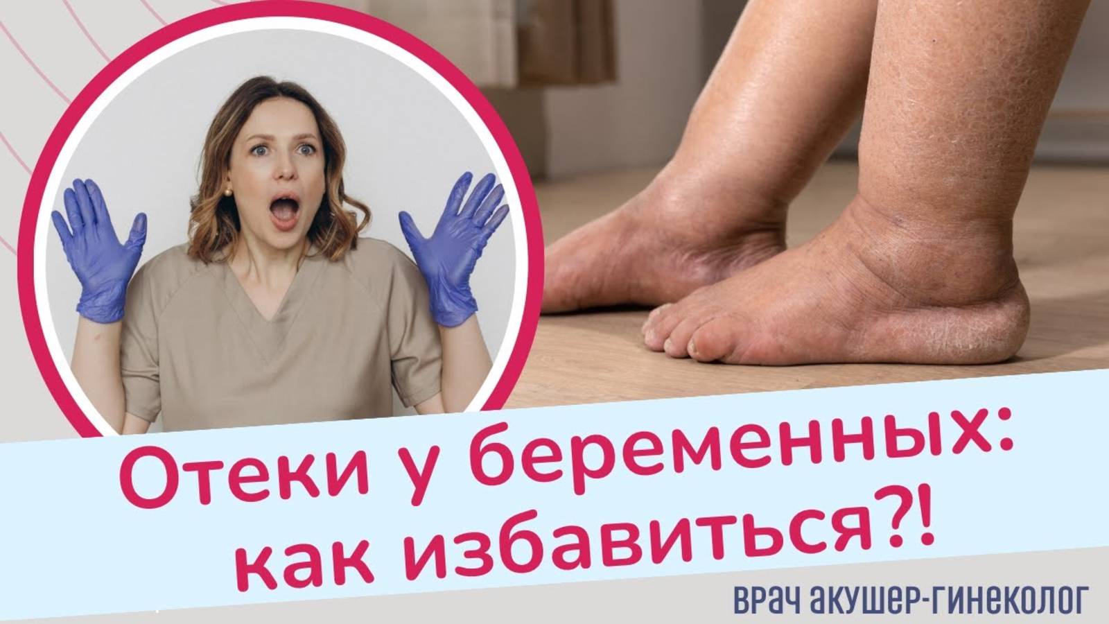 ОТЕКИ У БЕРЕМЕННЫХ. Почему появляются и как избавиться? смотреть онлайн