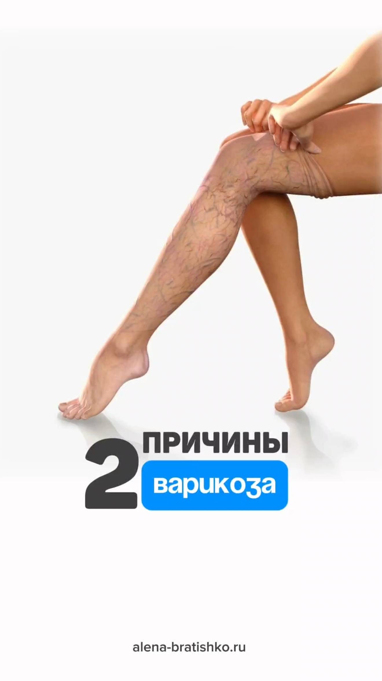 2 причины варикоза смотреть онлайн