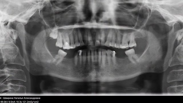 Установка-двух-имплантов