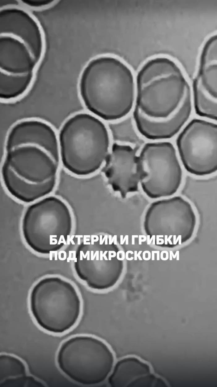 Бактерии, грибки, низкий гемоглобин под микроскопом. Алена Братишко смотреть онлайн